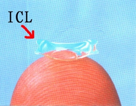 近视怎么办？贵州普瑞眼科近视矫正全方案