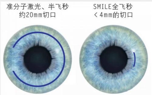 成年人近视还能恢复视力吗？