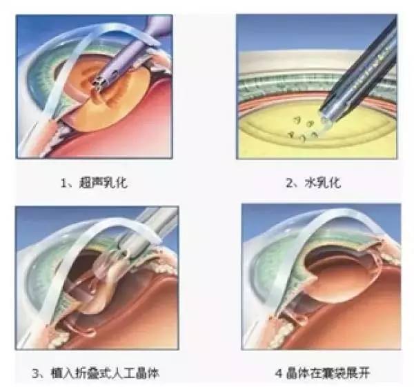 年轻时做近视手术,老了真的容易得白内障吗？